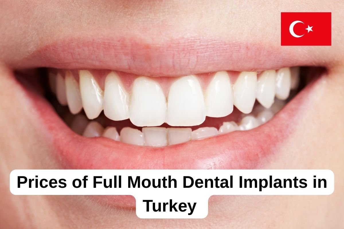 Full mouth dental implants